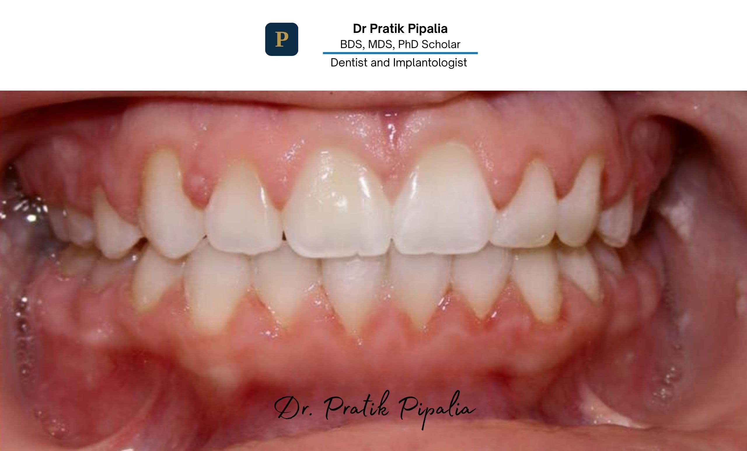 After · single implant