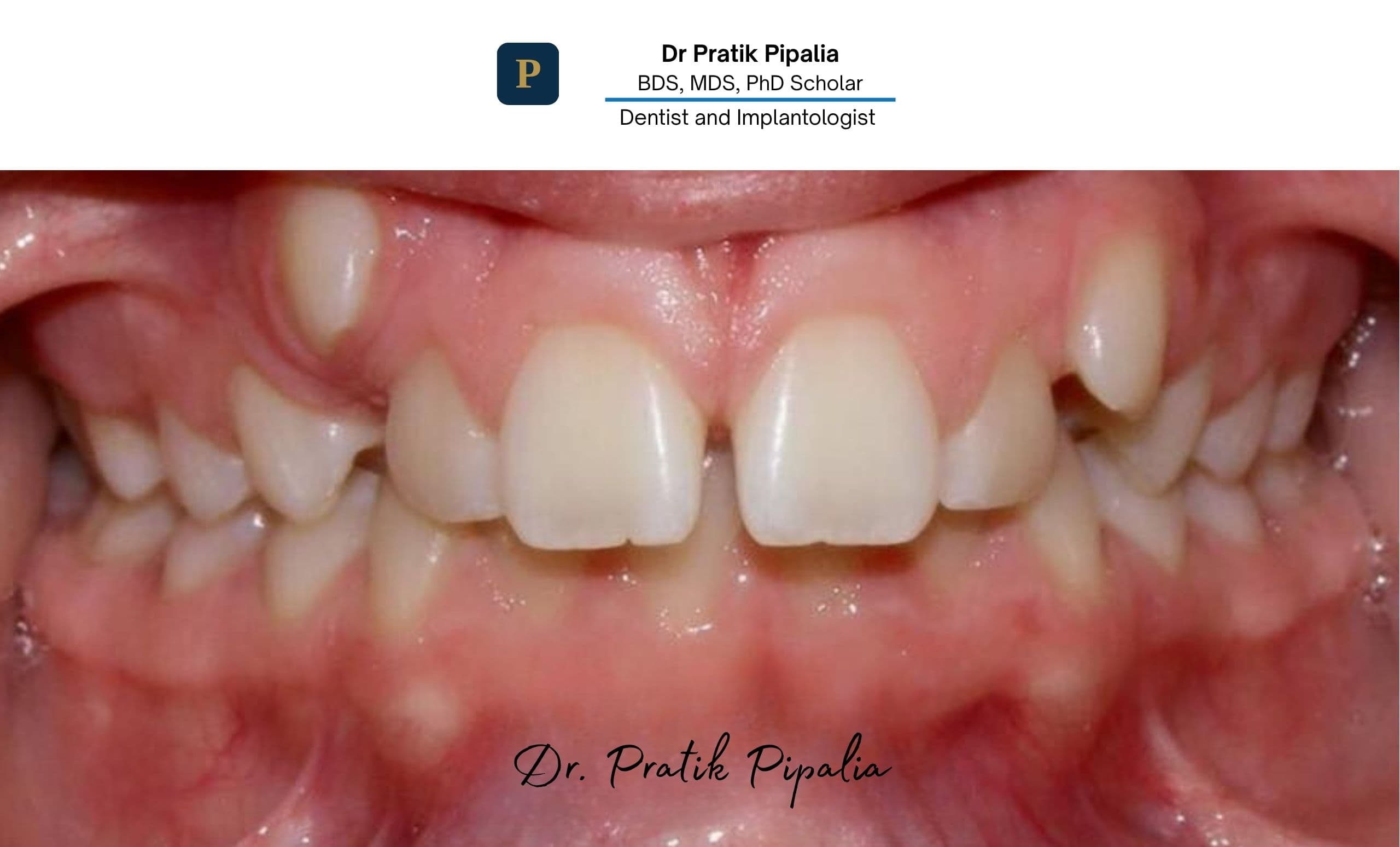 Before · missing molar