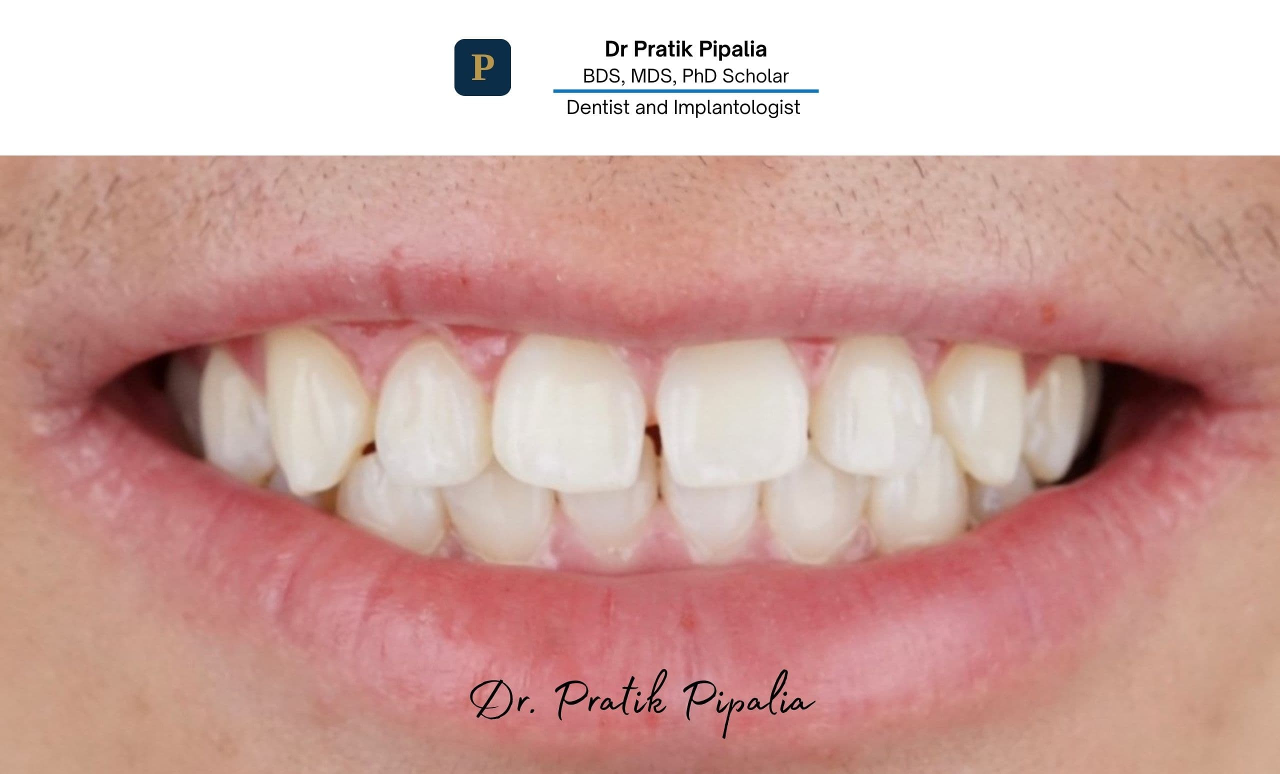 Before · failing dentition
