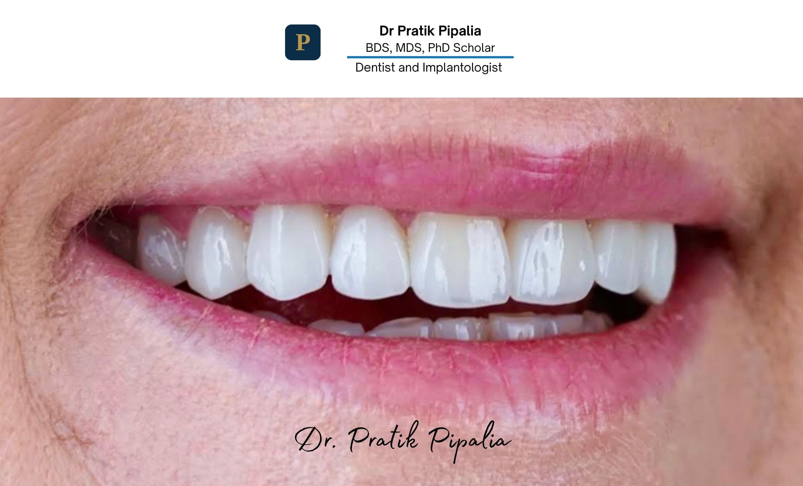 After · clear aligners